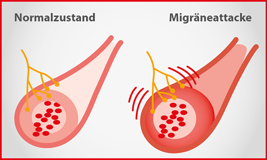 Migräne Blutgefäß Migräne Blutgefäß