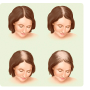 Haarausfall bei Frauen